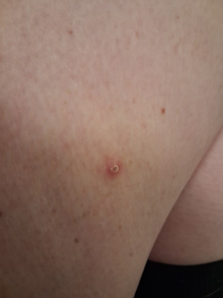 AIBU to worry about this thing on my leg I've had for several months?