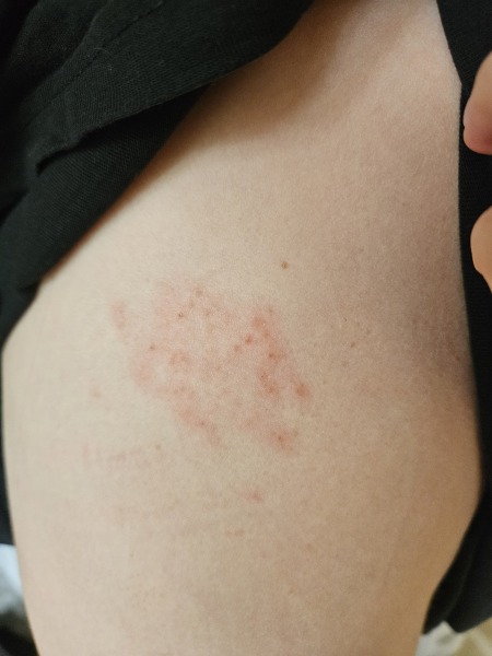 What is this rash?