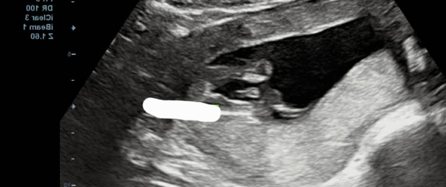 POTTY SHOT- BOY OR GIRL?
