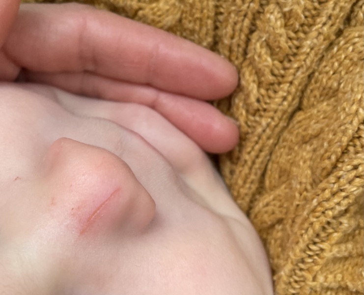 Scratch - what should I do?