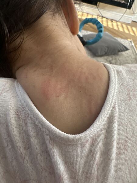 12 month old keeps itching back of her neck