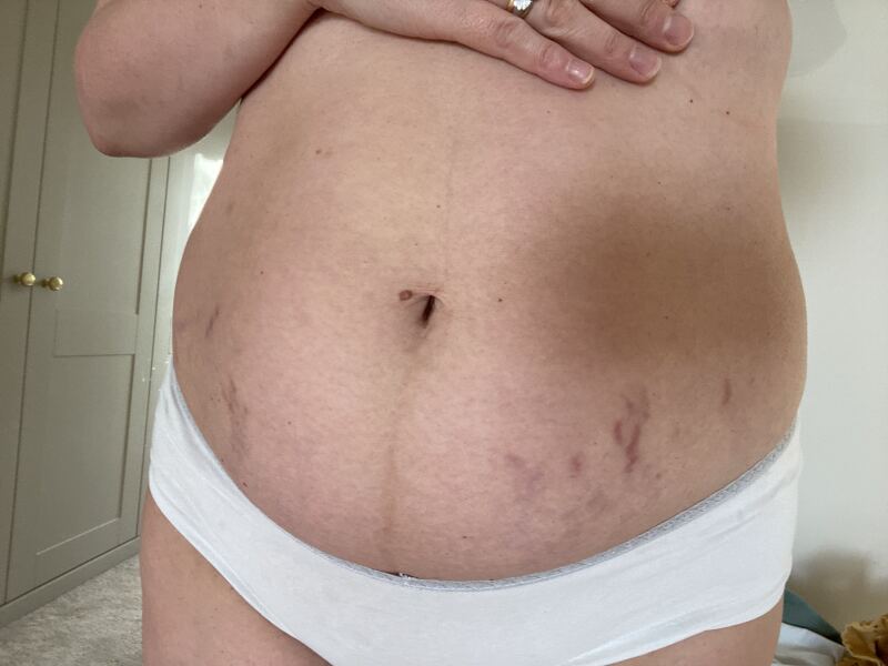 Is there any way to get rid of these marks?