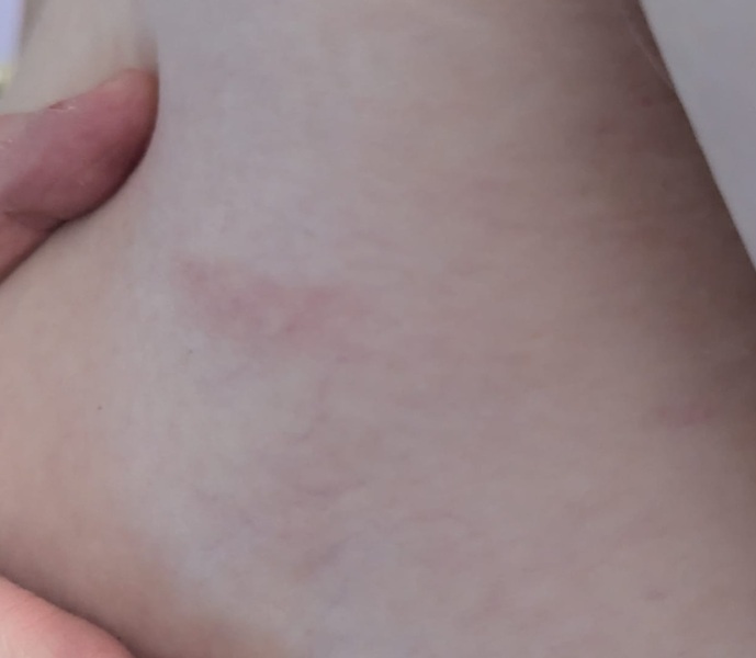 Surgery tomorrow- RASH with photos