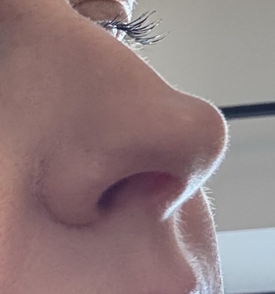 Rhinoplasty with pic