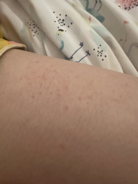 Help!! What is this rash??