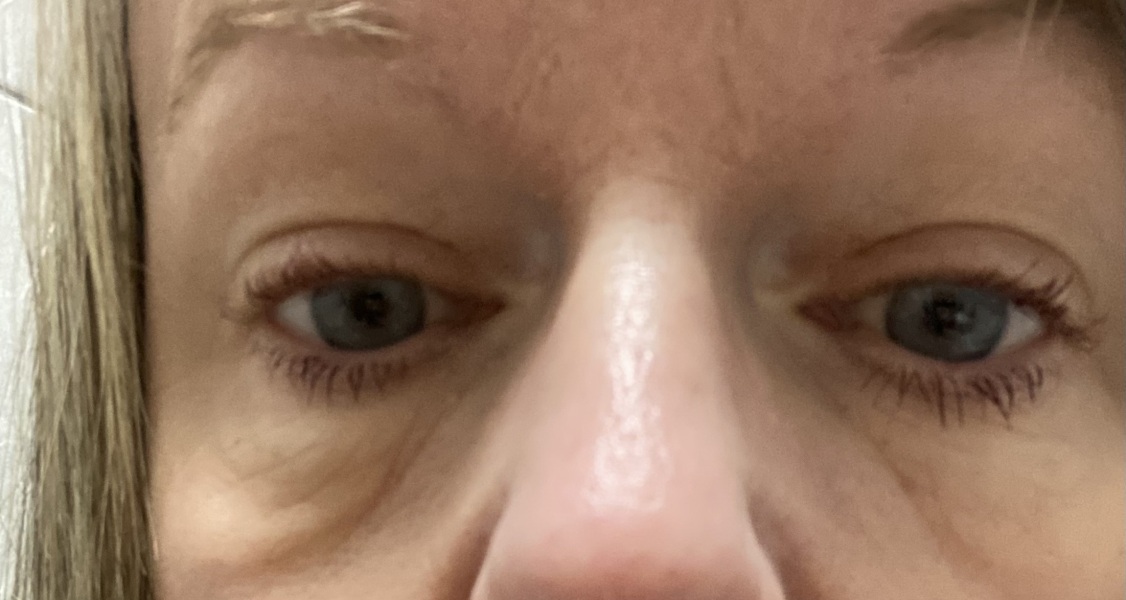 Eye Bag Help