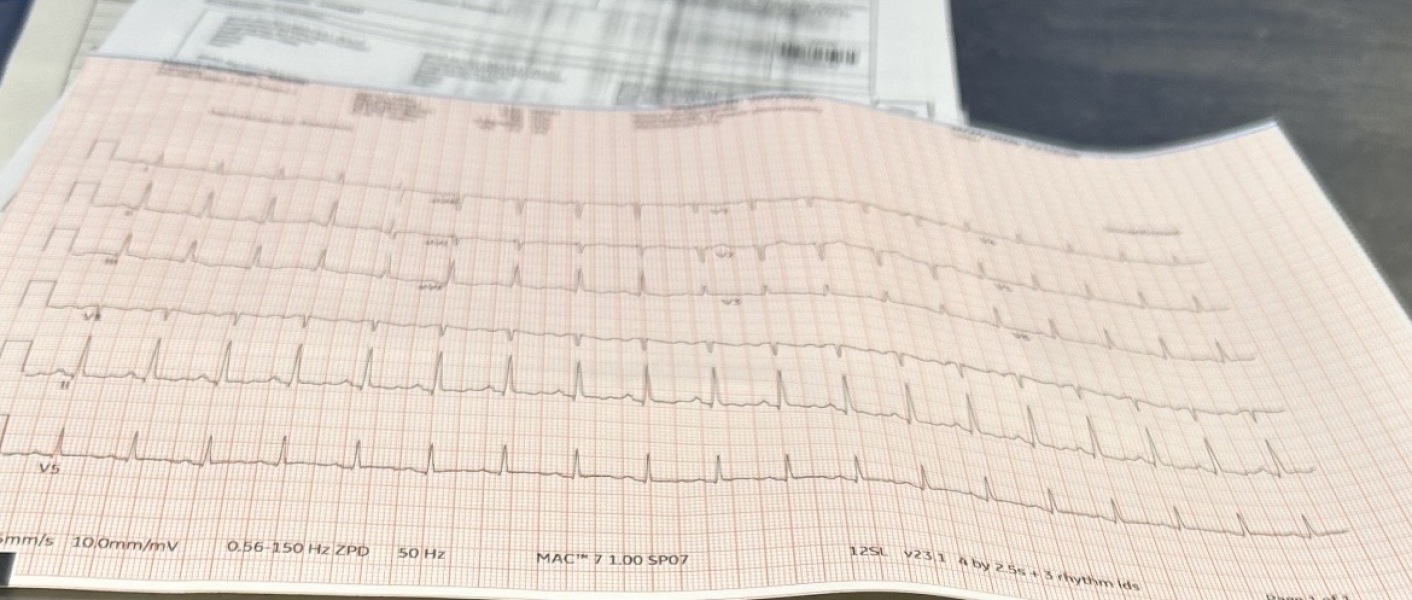 To ask if this looks like a normal ecg