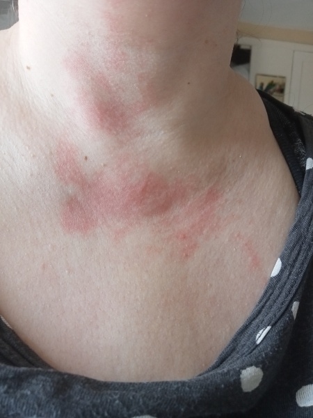 What are you up to today if you have a chronic illness? Thread 5