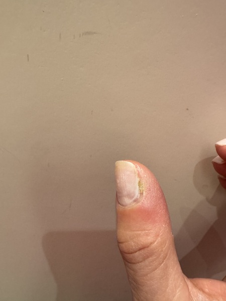 Nail gone weird after BIAB (photo attached)