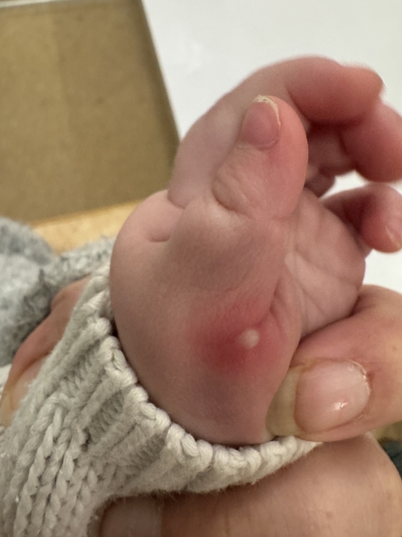 Chicken pox or something else? Picture