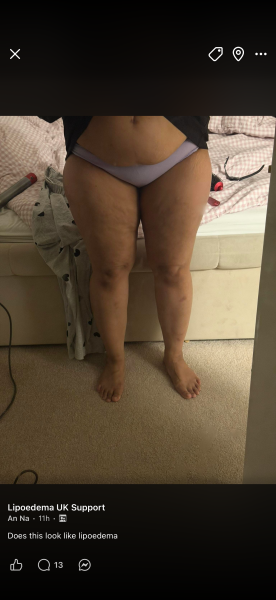 Lipoedema. Ugh 32 feels like life is over. Thought I was always fat