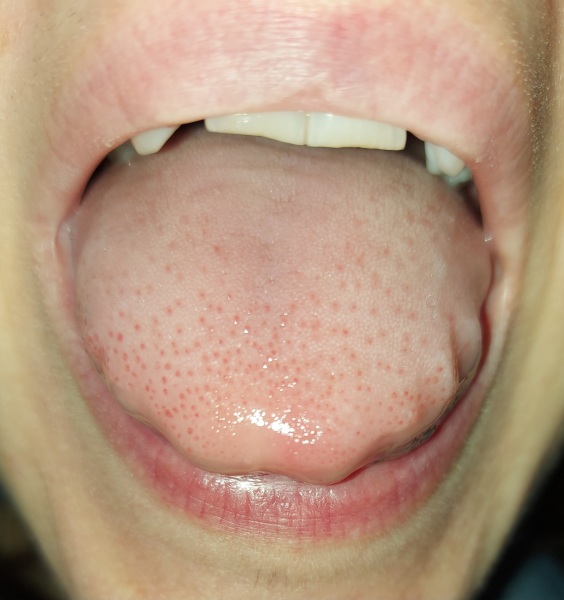 Sorry TMI, gross photos, but is this oral thrush or something else?