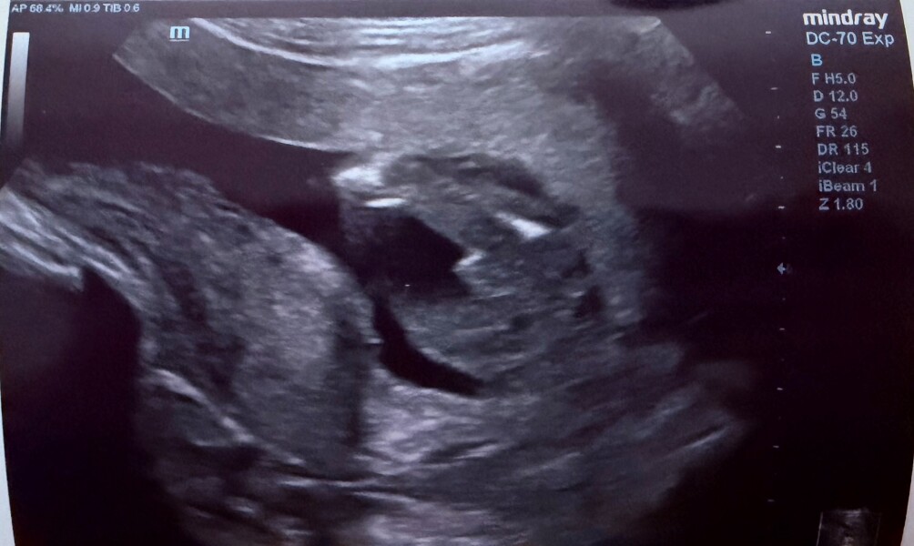 Gender Clues - Potty shot 17w 4 days