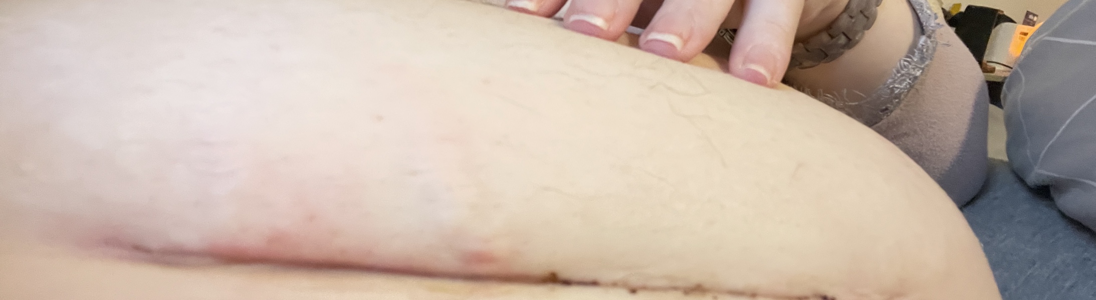 C section wound infection?