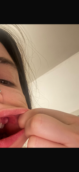 Tooth infection