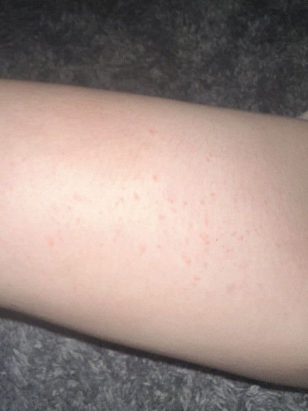 Help!! What is this rash??