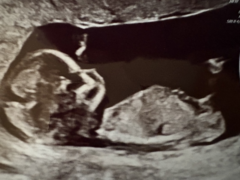 Anyone any good at nub theory? 2 boys and last baby