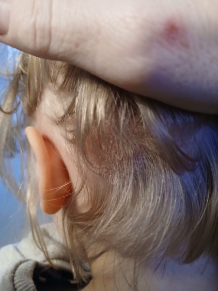 Scalp psoriasis in 3yr old girl