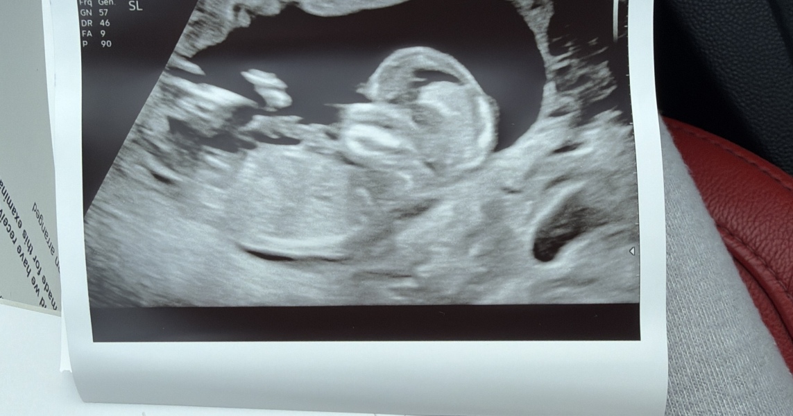 Nub theory? 12 weeks 4 days