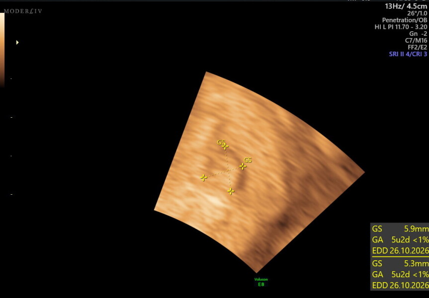 scan at 5 weeks 3 days, no heartbeats but possible twins (picture)