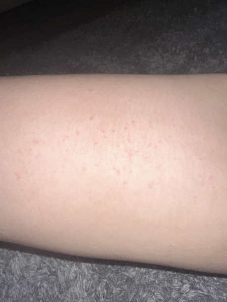 Help!! What is this rash??