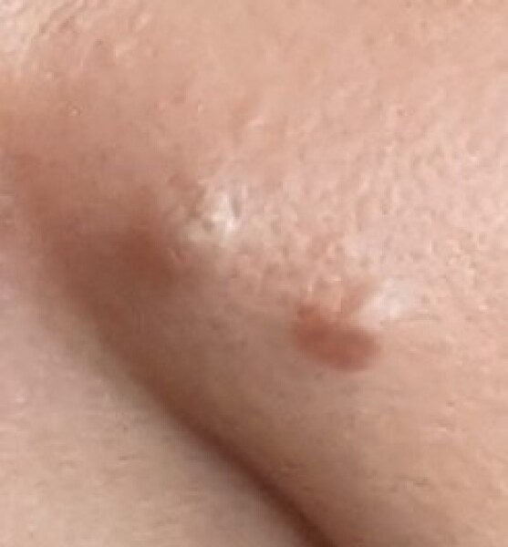 Has anyone had a facial mole removed?