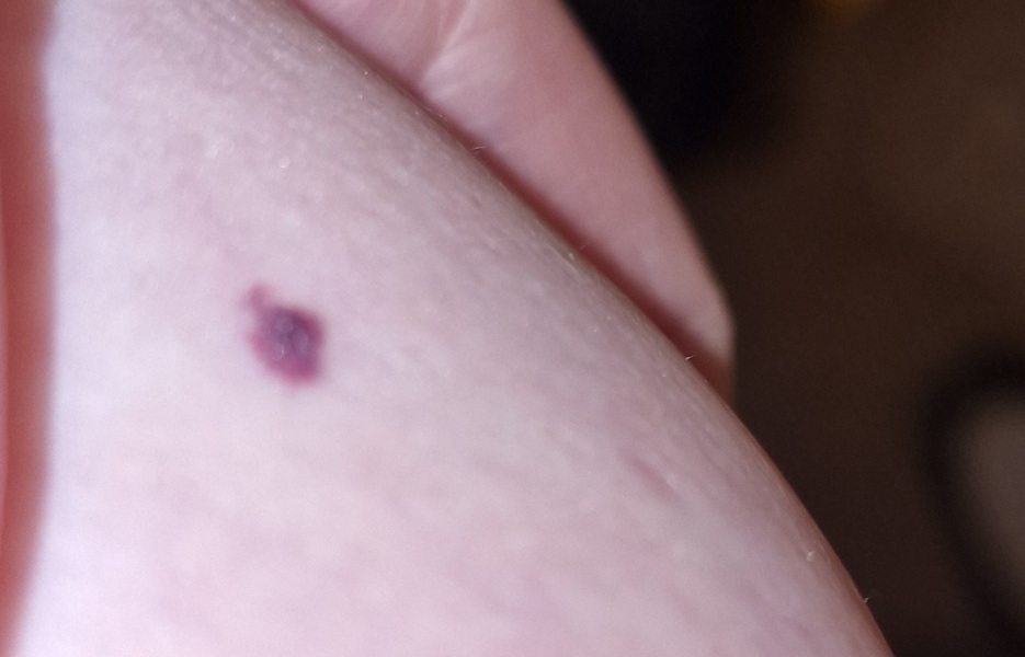 On a scale of 1-10, how worried would you be about this mole? Pic included. 