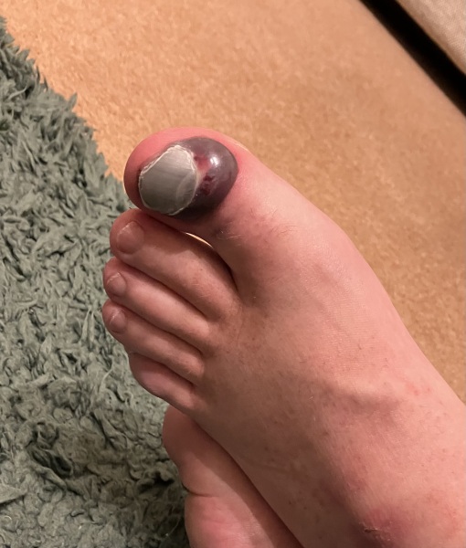 Does this need medical attention? (Yucky photo included)
