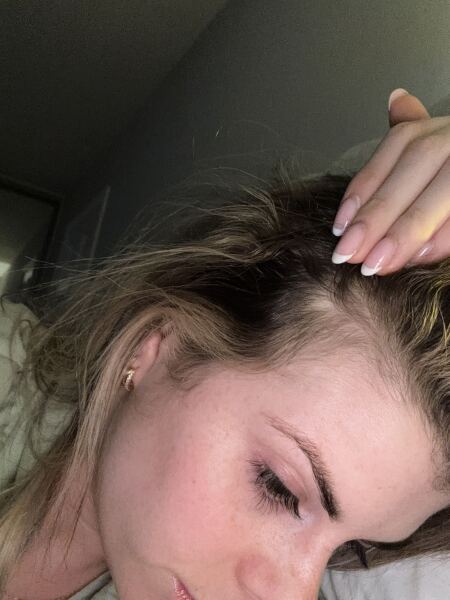 Is this alopecia ?