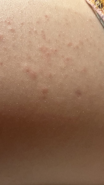 Help!! What is this rash??