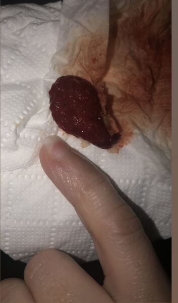 The best thing your body has produced *warning-grim content not suitable for weak-stomached persons*