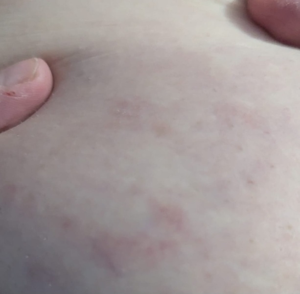 Surgery tomorrow- RASH with photos