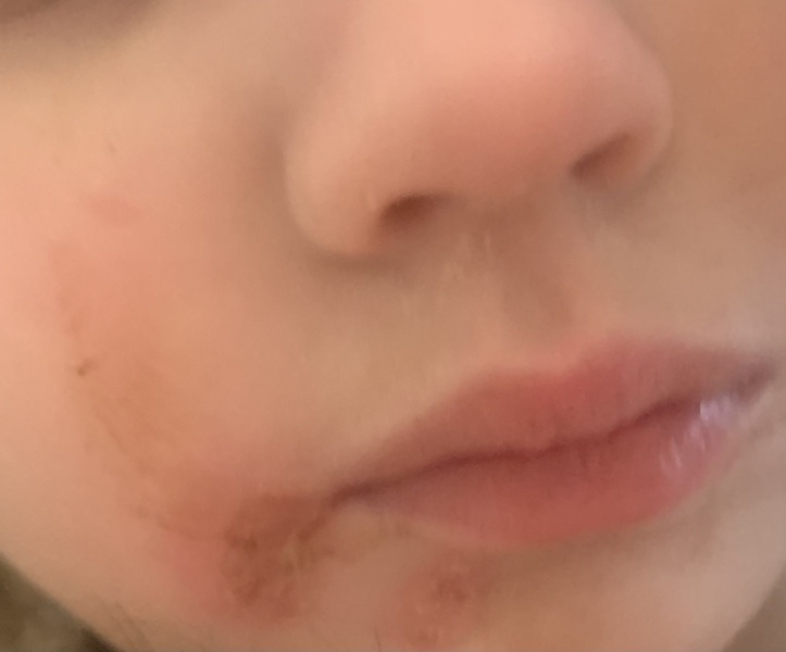Blisters on 3yo's face (Pic)