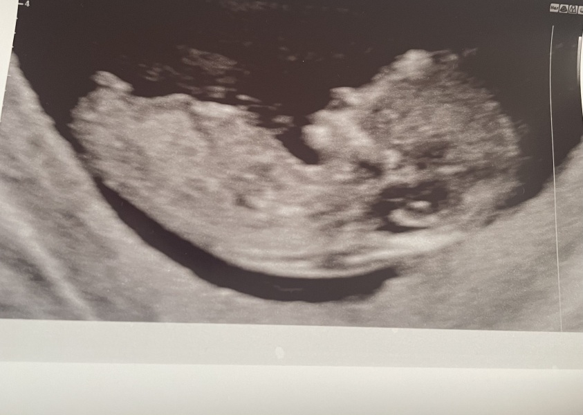 Boy or girl? 12 week scan