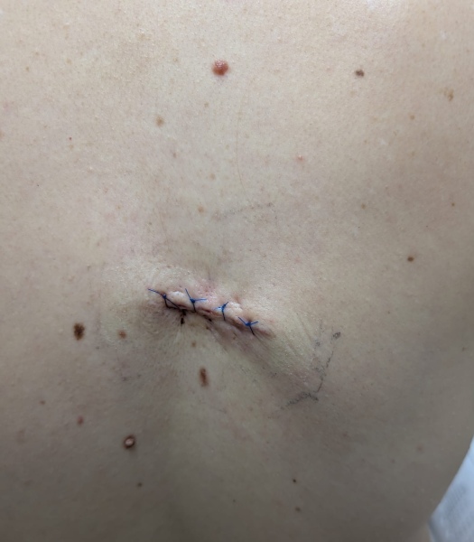 Mole excision on my back