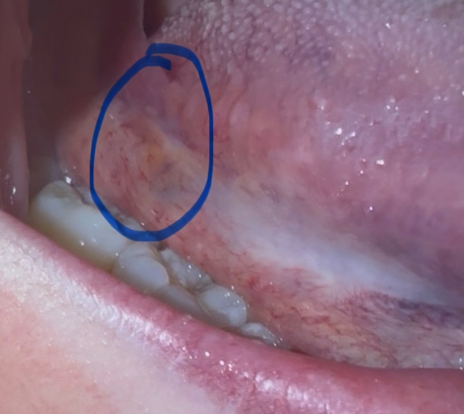 Please read/help. Brown patch on side of tongue, worried sick