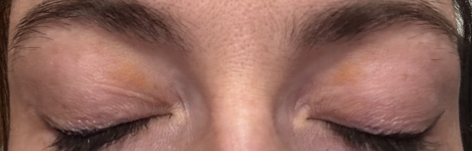 Yellow patches on eyelids