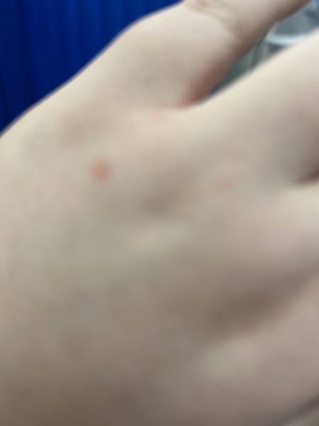 To ask if this looks more like a bite or skin irritation