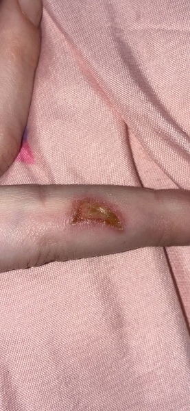 Any advice on this gross finger wound?