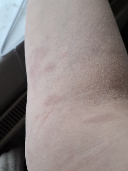 Surgery tomorrow- RASH with photos