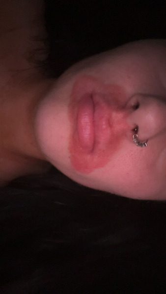 Perioral dermatitis