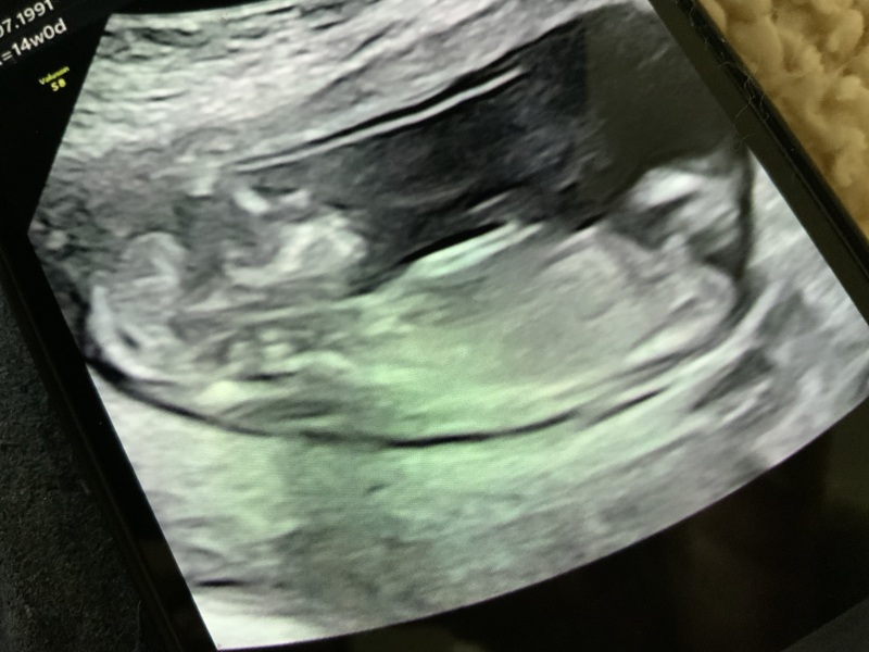 14 weeks boy or girl