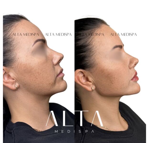 Cut glass jawlines on women