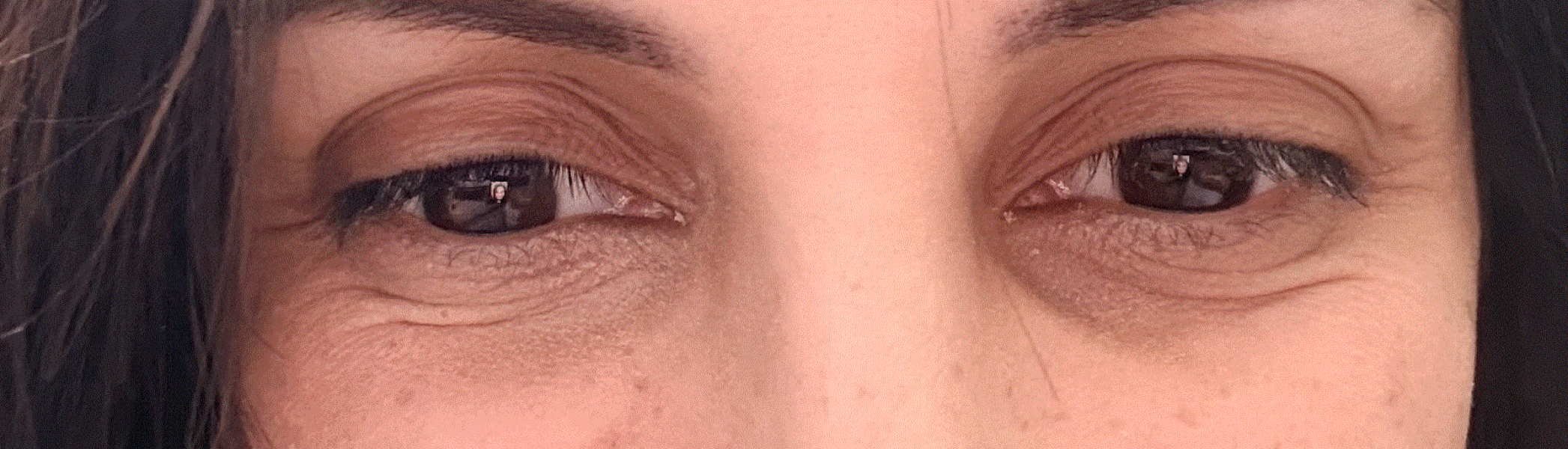 Eyebags - what procedure or creams can make them less visible? (pic attached)