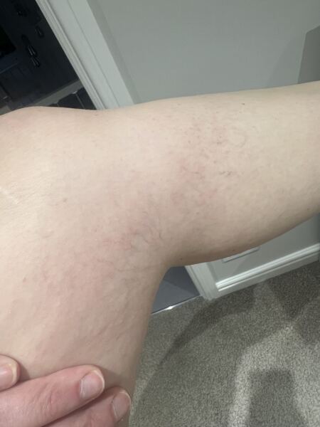 Thread veins on knees - photo included