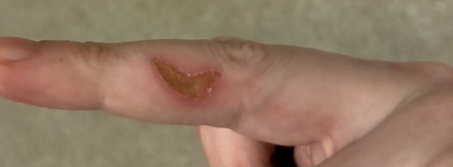 Any advice on this gross finger wound?