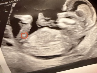 Nub theory? 12 weeks 4 days