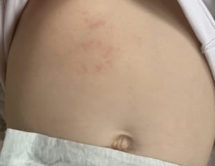 Rash on tummy