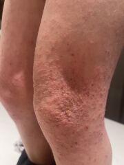 Photos - 5 year old rash that won’t heal