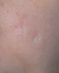 Has anyone had a facial mole removed?